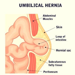 Umbillical hernia diagram